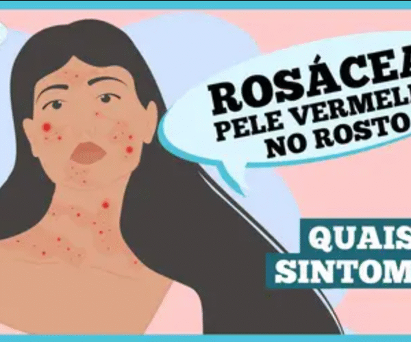 Rosácea: o que é e quais são os sintomas